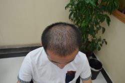 -大麦微针植发丨全国连锁