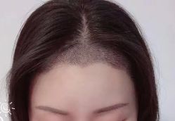-大麦微针植发丨全国连锁
