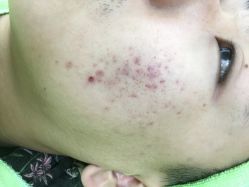 -苗医生草本科技祛痘