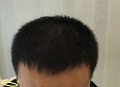 -大麦微针植发丨全国连锁