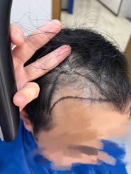 -大麦微针植发全国连锁