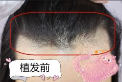 -大麦微针植发全国连锁