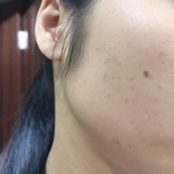 点击看大图 -清颜堂丨分子祛痘·功效美肤