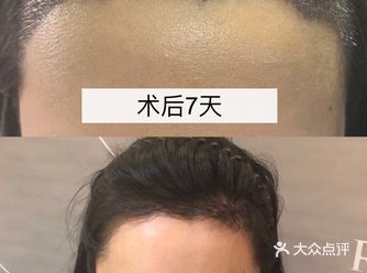 植发的发际线设计就是画一个圆弧吗