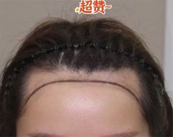 -大麦微针植发全国连锁