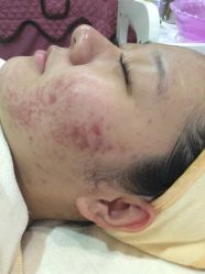 -苗方清颜专业祛痘