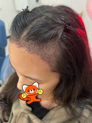 体验后-大麦微针植发全国连锁