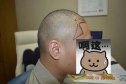 体验前-大麦微针植发全国连锁