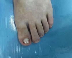 -德哥灰指甲脚气甲沟炎跖疣护理