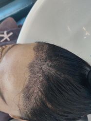 体验后-大麦微针植发全国连锁