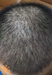 -大麦微针植发丨全国连锁