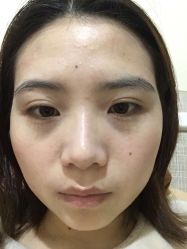 -美丽人生祛斑扁平疣汗管瘤中心