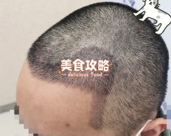 -大麦微针植发全国连锁