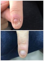 -德哥灰指甲脚气甲沟炎跖疣护理