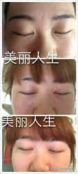 -美丽人生祛斑扁平疣汗管瘤中心
