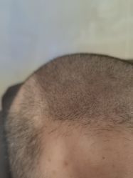 -碧莲盛·不剃发植发