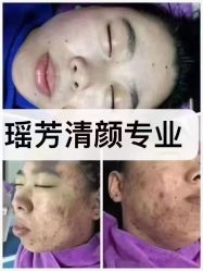 -瑶芳清颜草本祛痘