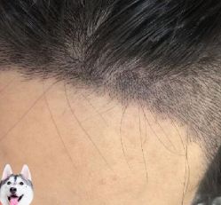 -大麦微针植发丨全国连锁