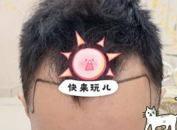 -大麦微针植发全国连锁