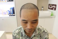 -大麦微针植发丨全国连锁