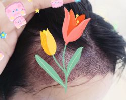 -大麦微针植发全国连锁