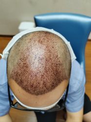 -大麦微针植发全国连锁