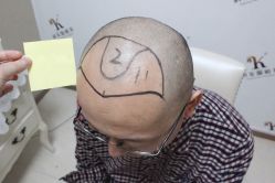 点击看大图 -大麦微针植发丨全国连锁