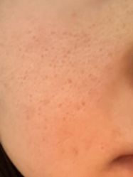 体验后-亿美医疗美容·半岛大超炮官方授权店