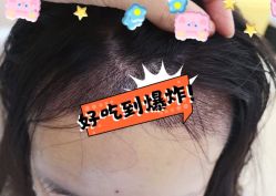 -大麦微针植发全国连锁