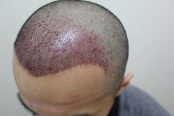 点击看大图 -大麦微针植发丨全国连锁