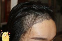 -大麦微针植发丨全国连锁