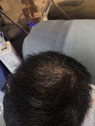 -碧莲盛·不剃发植发