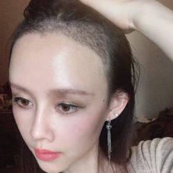 -碧莲盛·不剃发植发
