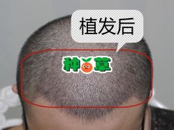 -大麦微针植发全国连锁