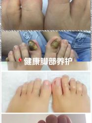 -德哥灰指甲脚气甲沟炎跖疣护理