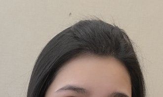 -大麦微针植发丨全国连锁