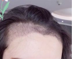 点击看大图 -大麦微针植发全国连锁