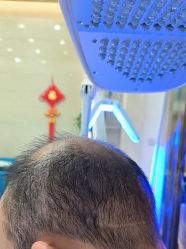点击看大图 -碧莲盛·不剃发植发