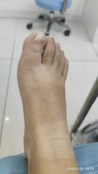 -派恩宜灰指甲鸡眼嵌甲手足癣