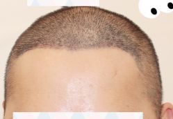 -大麦微针植发全国连锁