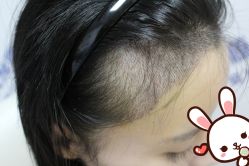 -大麦微针植发丨全国连锁