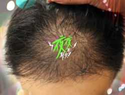 -大麦微针植发全国连锁