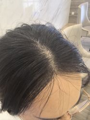 -大麦微针植发丨全国连锁