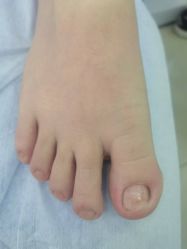 -德哥灰指甲脚气甲沟炎跖疣护理