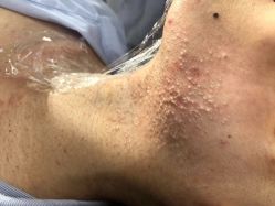 -美丽人生祛斑扁平疣汗管瘤中心
