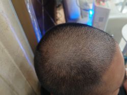 -碧莲盛·不剃发植发