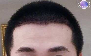 -大麦微针植发丨全国连锁