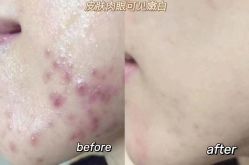 -瑶芳清颜草本祛痘