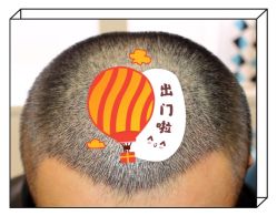 -大麦微针植发全国连锁