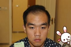 点击看大图 -大麦微针植发丨全国连锁